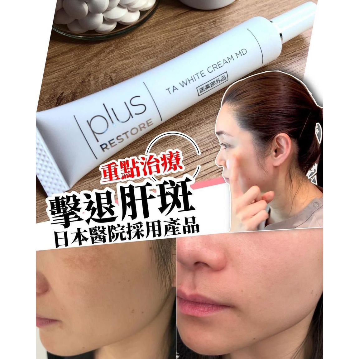 $210/1。日本 医疗级 黑斑救星 10g