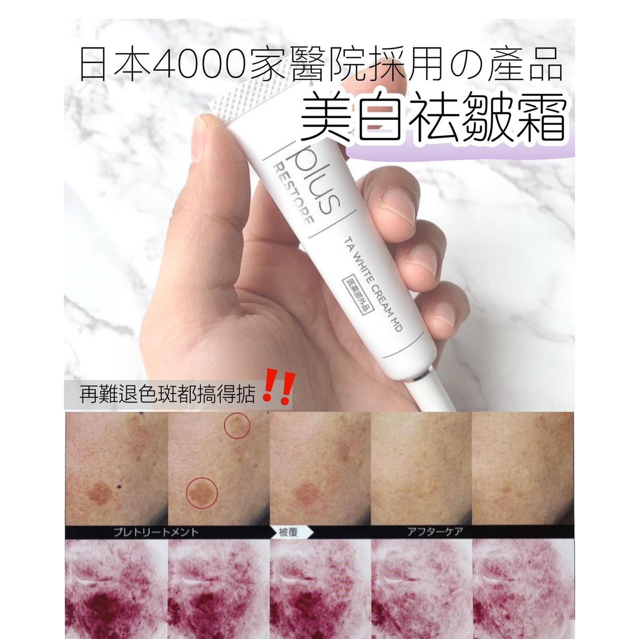 $2O8支。2支起$198支。日本 醫療級 黑斑救星 10g
